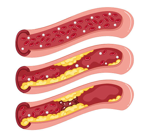 [Translate to Italiano:] Grafische Darstellung: Illustration der Entstehung von Arteriosklerose. Erkennbar sind eine Arterie, Plaques und rote Blutkörperchen.